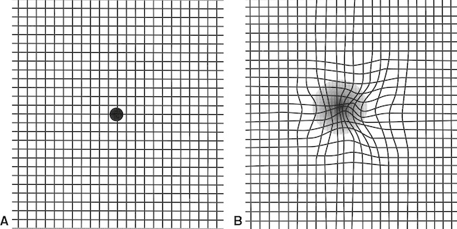 Grille A normale et grille B déformée, indiquant une atteinte possible de la vision centrale liée à la zone maculaire.
