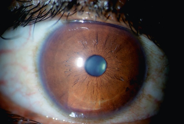 Vue rapprochée d’un segment antérieur oculaire normal. Cornée claire, iris structuré et pupille centrée sans anomalie apparente.