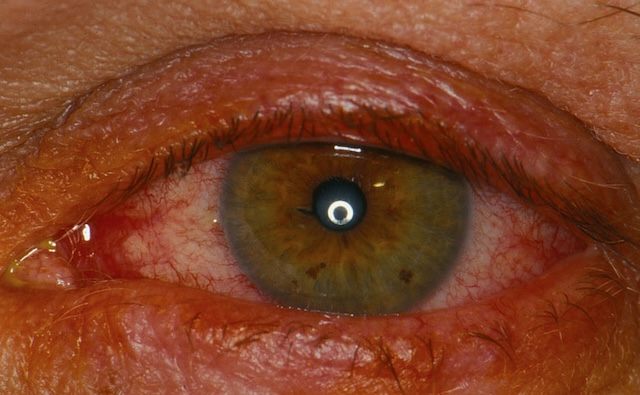 Œil rouge avec conjonctive irritée, photo prise en lumière directe.