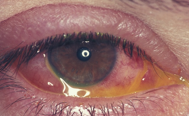 Photographie montrant une rougeur conjonctivale diffuse associée à des sécrétions visibles dans le cul-de-sac inférieur.