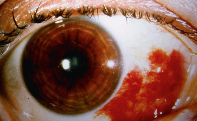 Hémorragie sous-conjonctivale visible, sans atteinte cornéenne. Aspect localisé, non inflammatoire, avec pupille centrée et iris net.