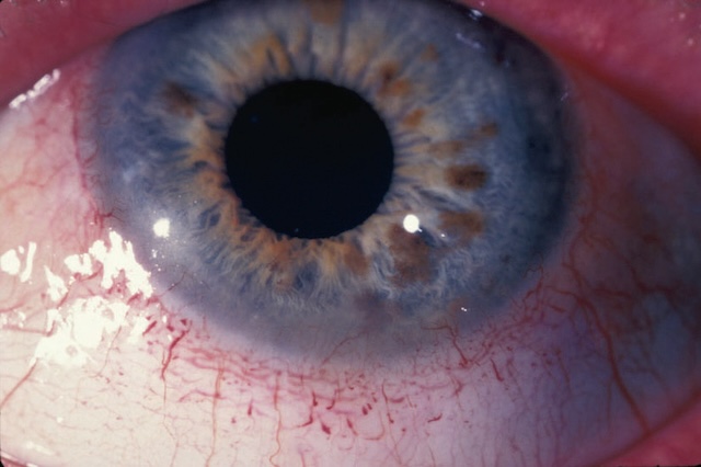 Photo montrant un cercle périkératique autour de la cornée, avec vaisseaux visibles.