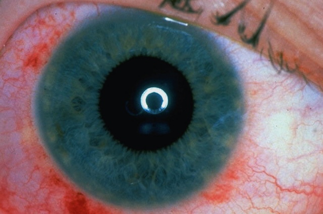 Photographie montrant un cercle périkératique marqué autour de la cornée avec injection ciliaire localisée.