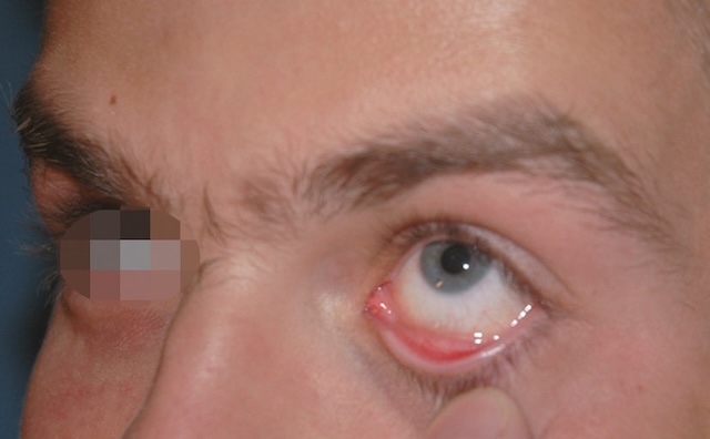 Examen visuel simple du cul-de-sac conjonctival inférieur sans anomalie, muqueuse rosée apparente.