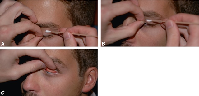 Photos montrant le retournement manuel de la paupière pour examiner la conjonctive supérieure.