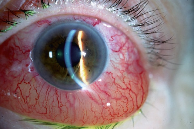 Photographie en gros plan montrant un chémosis avec œdème conjonctival marqué et vaisseaux dilatés.