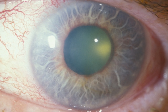 Cornée trouble et opacifiée dans un contexte évocateur de glaucome aigu avec œdème cornéen.