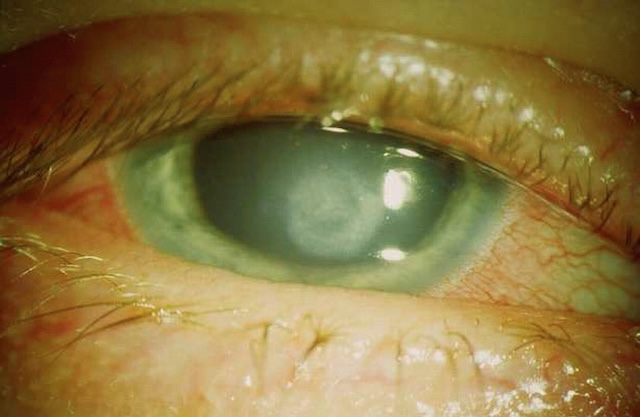 Photo montrant une cornée partiellement opaque, avec perte de transparence au centre.