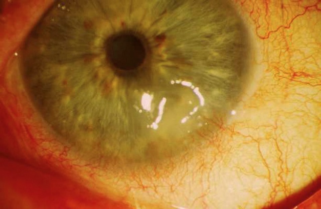Photographie montrant une ulcération cornéenne visible sous forme de lésion blanchâtre centrale entourée de vaisseaux dilatés.