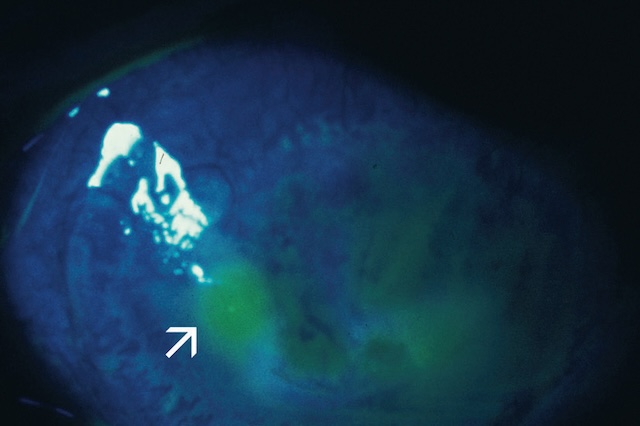Ulcération cornéenne visualisée en lumière bleue grâce à la fluorescéine, signalant une lésion épithéliale active.