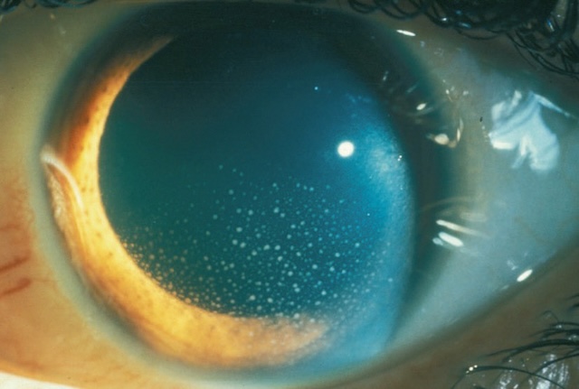 Multiples précipités rétrocornéens visibles en lumière focalisée, évoquant une uvéite antérieure avec atteinte inflammatoire de la chambre antérieure.