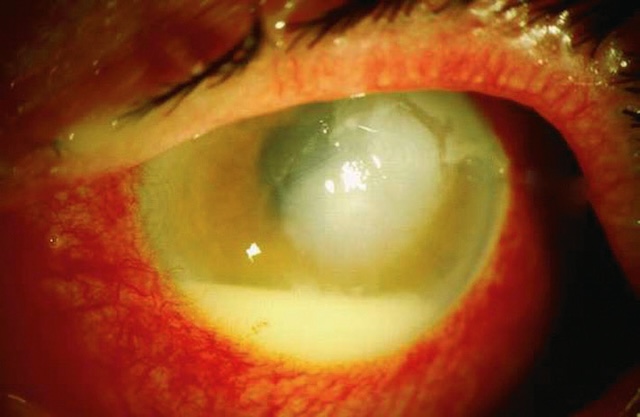 Accumulation purulente déclive en chambre antérieure, typique d’un hypopion dans un contexte inflammatoire ou infectieux aigu.