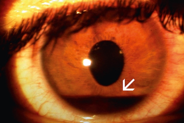 Accumulation de sang dans la chambre antérieure de l’œil, caractéristique d’un hyphéma post-traumatique.