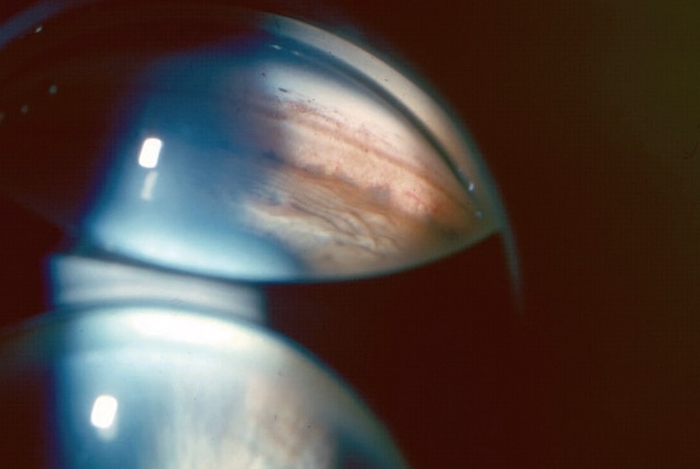 Gonioscopie montrant un angle iridocornéen ouvert avec structures visibles, utile pour évaluer le drainage de l’humeur aqueuse.