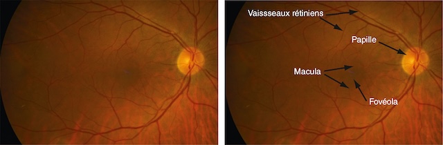 Fond d’œil clair montrant une papille nette, des vaisseaux bien dessinés, une macula pigmentée et une fovéola visible sans anomalie.