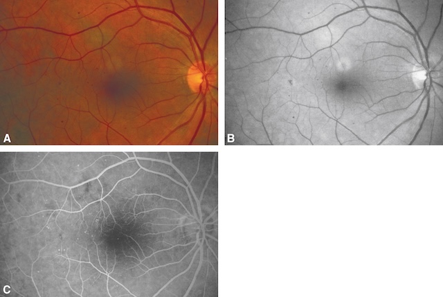 Photographies de fond d’œil illustrant la présence de microanévrismes rétiniens à travers des vues couleur, noir et blanc et fluorescéine.