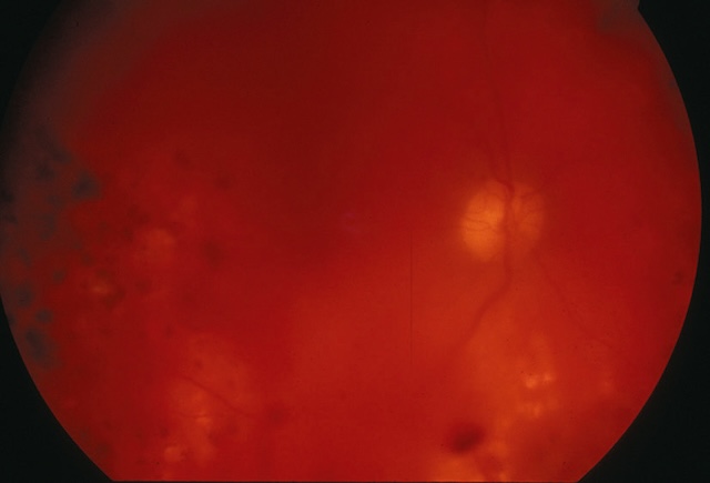 Hémorragie intravitréenne partielle avec visualisation atténuée de la rétine, suggérant un saignement modéré sans perte complète de visibilité.