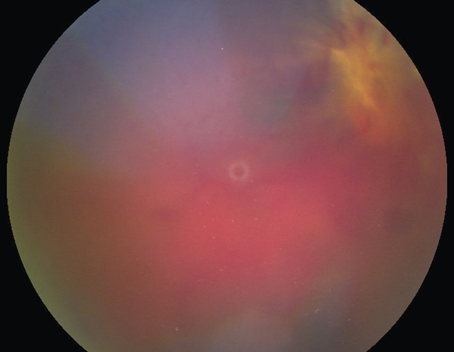 Photographie rétinienne montrant un vitré opacifié par une hémorragie diffuse, masquant totalement les structures rétiniennes.