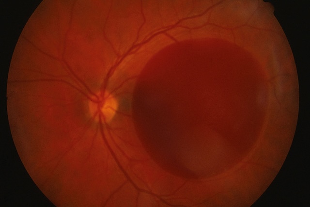 Vue du fond d’œil montrant une large tâche rouge homogène devant la rétine, masquant les vaisseaux. Papille visible, fond orangé, type imagerie rétinienne.
