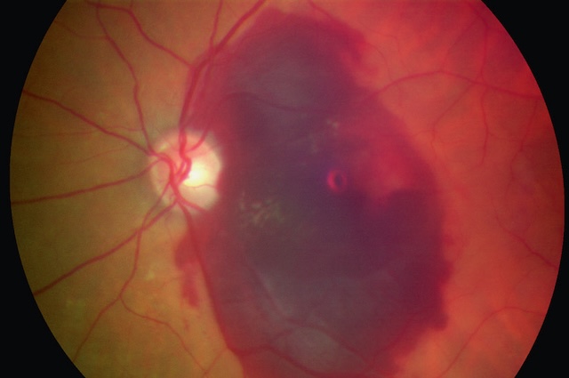 Vue du fond d’œil montrant une hémorragie sous-rétinienne étendue. Les vaisseaux restent visibles et la papille n’est pas masquée.