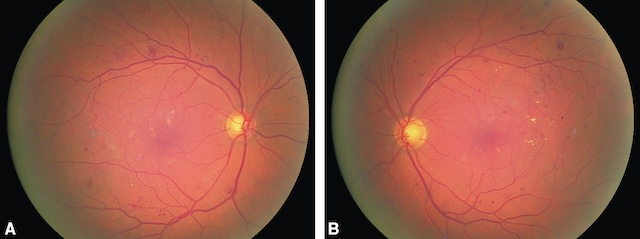Photographies de fond d’œil montrant des hémorragies punctiformes et exsudats profonds, indiquant une rétinopathie bilatérale modérée.