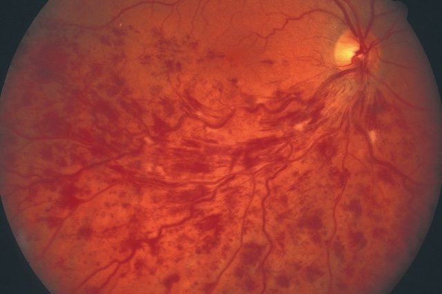 Présence d’hémorragies en flammèches, suivant les fibres nerveuses autour de la papille.