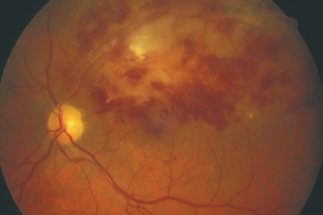 Fond d’œil montrant hémorragies en taches étendues et nodules cotonneux, traduisant une rétine ischémiée et fragilisée.