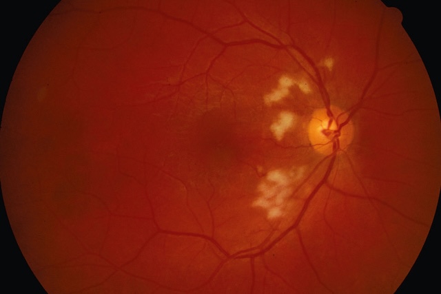Vue du fond d’œil avec foyers blanchâtres flous proches de la papille. Aspect typique de nodules cotonneux, imagerie de type rétinienne.