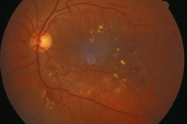 Fond d’œil montrant des exsudats lipidiques profonds autour de la macula. La papille est nette, les vaisseaux restent bien visibles.