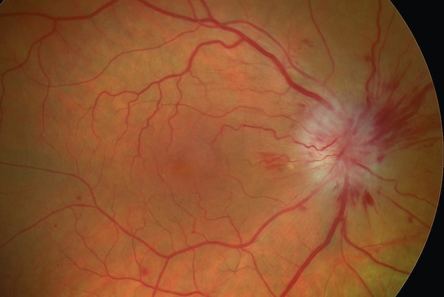 Œdème papillaire marqué avec hémorragies en flammèches, suggérant une neuropathie optique ischémique.