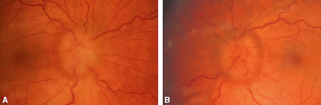 Œdème bilatéral du nerf optique avec bords flous et bombement papillaire, évocateur d’une hypertension intracrânienne.