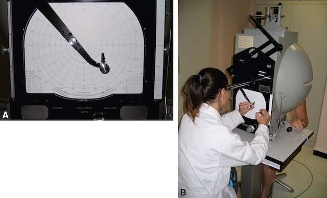 Deux clichés illustrent une évaluation du champ visuel en périmétrie cinétique, dirigée par une orthoptiste. Une méthode clinique de cartographie visuelle dans un contexte ophtalmologique.