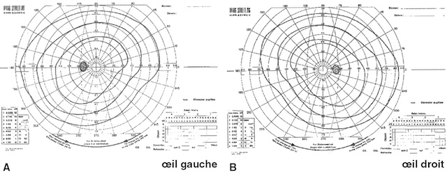 Champ visuel normal aux deux yeux avec tracés réguliers et symétriques, sans anomalie périmétrique décelable.