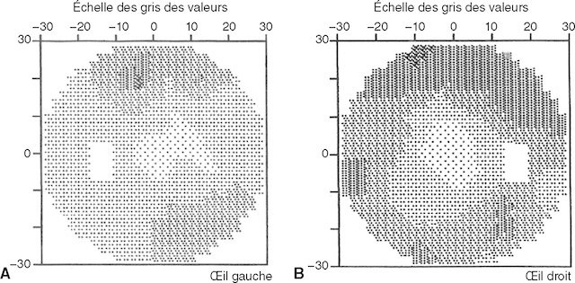 Cartographie du champ visuel central pour chaque œil par périmétrie automatisée. Déficits perceptibles en zones grises suggérant une atteinte visuelle.