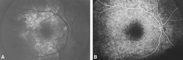 Progression du contraste dans les artères (A), puis dans les veines (B), observée en angiographie du fond d’œil. Vue directe de la circulation rétinienne.