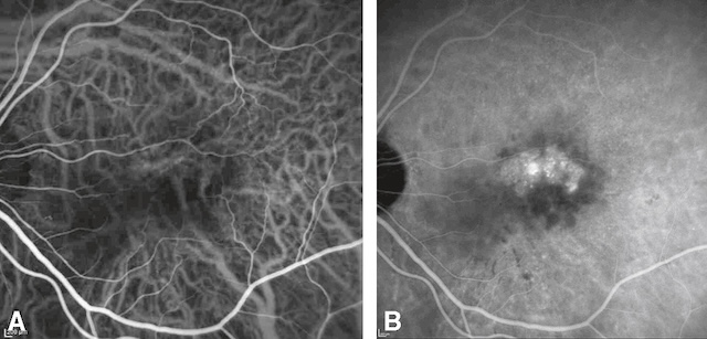 Angiographie à la vert d’indocyanine montrant des néovaisseaux choroïdiens occultes dans une DMLA, avec hypercyanescence centrale inhomogène.