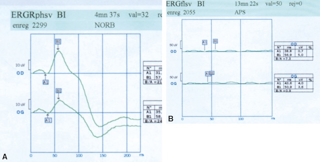 Comparaison entre deux électrorétinogrammes montrant une réponse normale à gauche et une absence de réponse à droite, évoquant une atteinte sévère de la rétine.