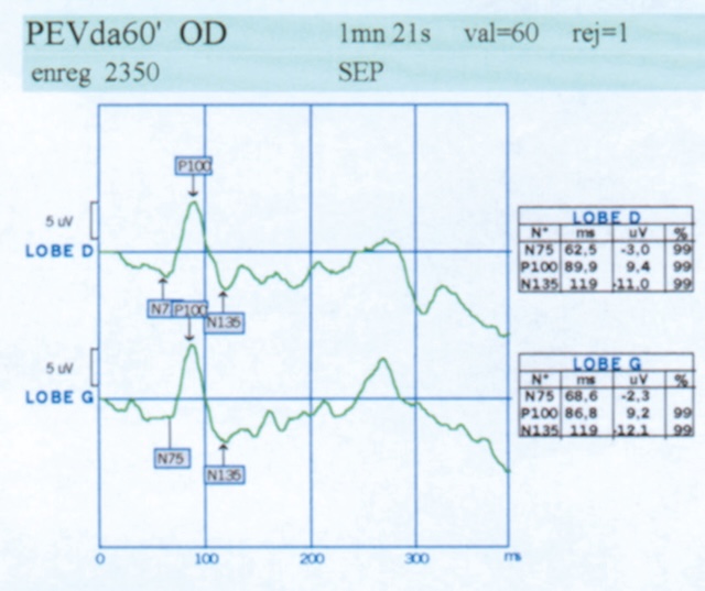 Courbes mesurant les réponses cérébrales à un stimulus visuel, avec analyse comparative entre les deux hémisphères.