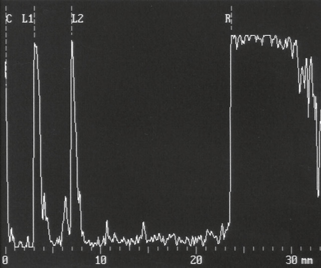 Échographie A montrant une longueur axiale de 23–24 mm, révélatrice d’une myopie par mesure biométrique de l’œil.