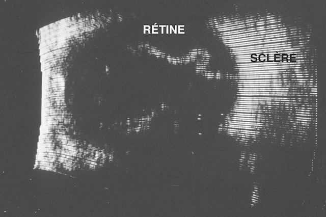 Décollement de rétine visible en échographie B avec soulèvement rétinien net devant la sclère. Image de diagnostic ophtalmique ciblé.
