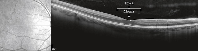 OCT rétinienne normale avec fovéa centrée, couches bien définies et aucune anomalie morphologique détectée.