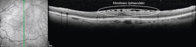 Coupe OCT montrant une membrane épirétinienne entraînant une distorsion de la surface rétinienne avec bombement et traction au niveau maculaire.