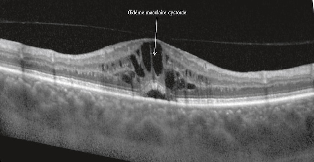Coupes OCT révélant un œdème maculaire cystoïde sous forme de cavités intrarétiniennes au niveau central.