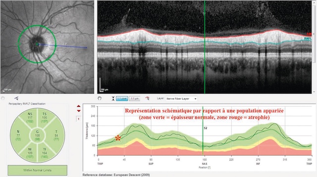Analyse OCT du nerf optique montrant une épaisseur normale des fibres nerveuses. Aucun signe d’atrophie détecté. Résultat dans les limites normales.