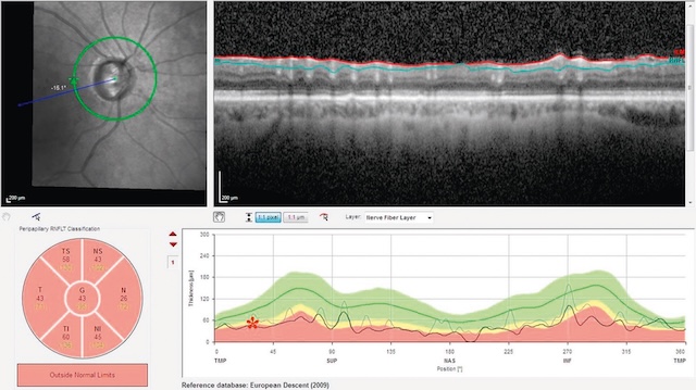 OCT papillaire montrant une excavation marquée avec perte sévère de fibres nerveuses rétiniennes, suggérant une atteinte glaucomateuse.