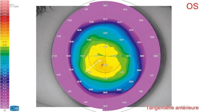 Topographie de l’œil gauche indiquant un astigmatisme régulier bien centré, sans anomalie évidente.
