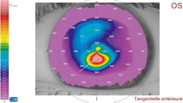 Topographie cornéenne OS montrant une déformation asymétrique évocatrice d’un kératocône avec astigmatisme irrégulier.