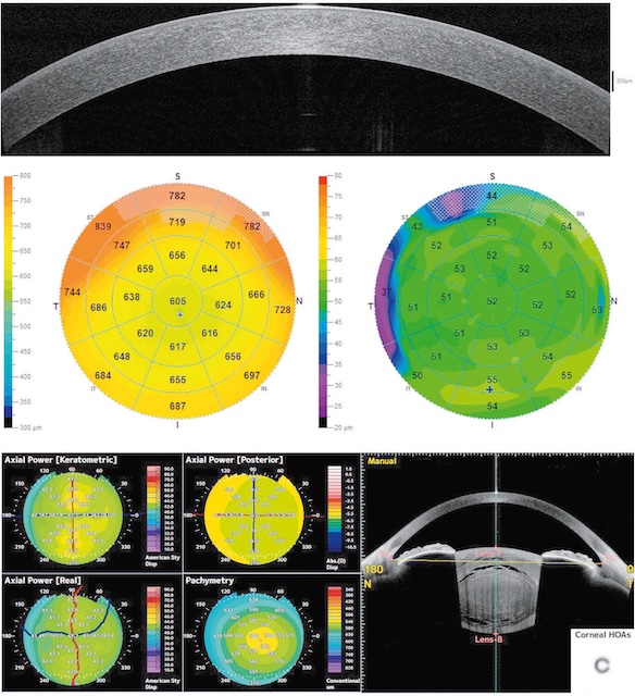 OCT du segment antérieur montrant une cornée régulière et bien centrée. Épaisseur homogène, sans anomalie détectée sur les cartes topographiques.