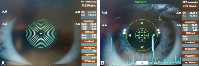 Biométrie optique de l’œil gauche montrant kératométrie, longueur axiale et ACD avec interférométrie pour calcul préopératoire de l’implant intraoculaire.