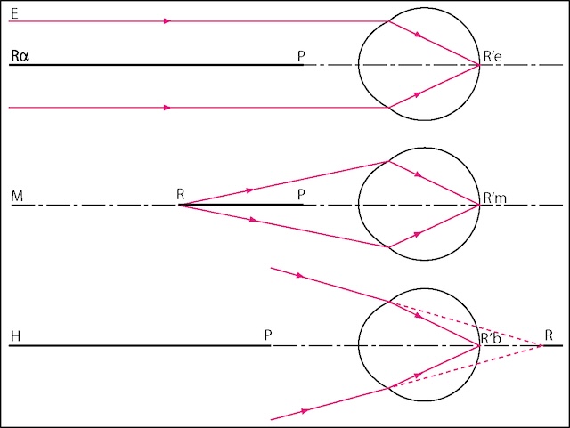 Trois profils visuels comparés selon la zone de netteté : normal, flou de loin (myopie) ou effort même au repos (hypermétropie).